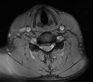 Cervical Disc Herniation