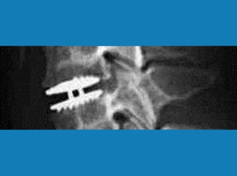 Cervical artificial disc replacement