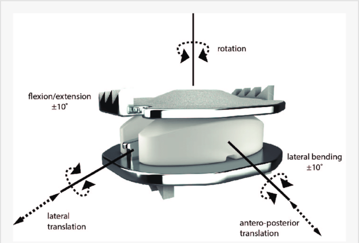 Artificial disc replacement